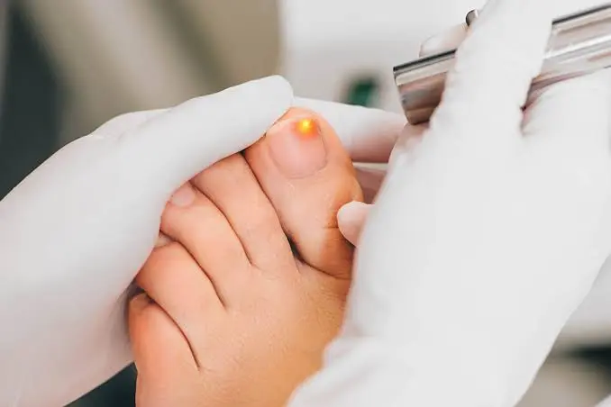 Laser nail fungal treatment being performed on a client's toe at AV Glow Bar